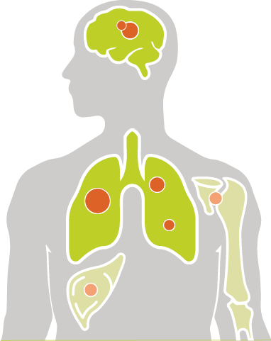 ALK+ NSCLC can metastasize to other areas of the body including the brain, liver, or bones.